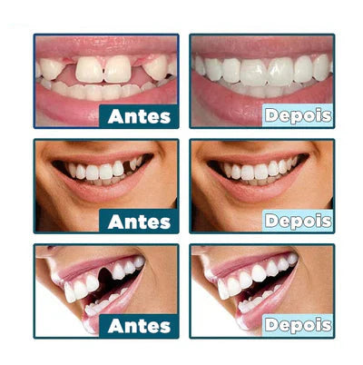 Facetas Dentárias Naturais,Elegante Branco Silicone Dentes Ferramenta Temporária Sorriso Perfeito Superior Inferior Falso